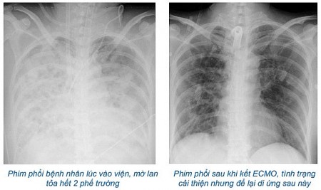 Nữ bệnh nhân bị suy đa tạng vì tự chữa cúm bằng thuốc chống viêm